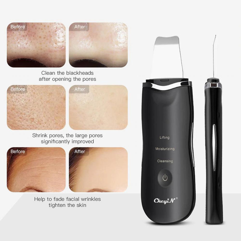 Facial Skin Scrubber Ultrasonic Blackhead Remover Shovel